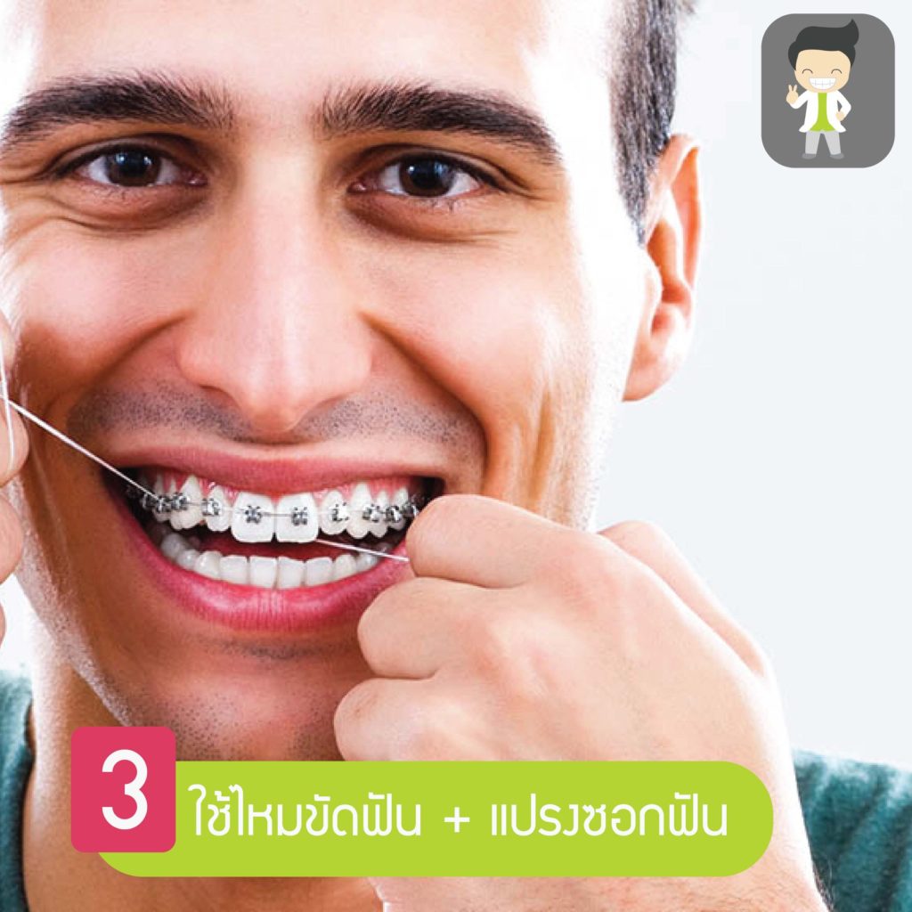 ยิ้มสวยไม่สะดุด! กับ 5 เคล็ดลับง่ายๆ ดูแลช่องปากสำหรับคนจัดฟัน 4 33384984 2062980093918042 1542207831258693632 o