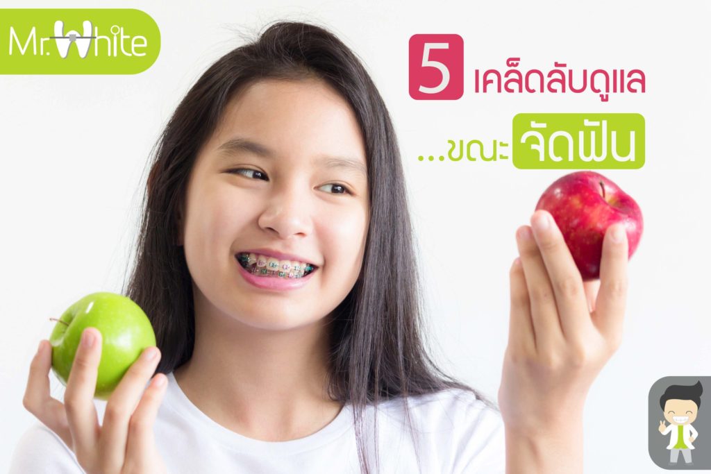 ยิ้มสวยไม่สะดุด! กับ 5 เคล็ดลับง่ายๆ ดูแลช่องปากสำหรับคนจัดฟัน 2 33595639 2062979977251387 144189211837202432 o