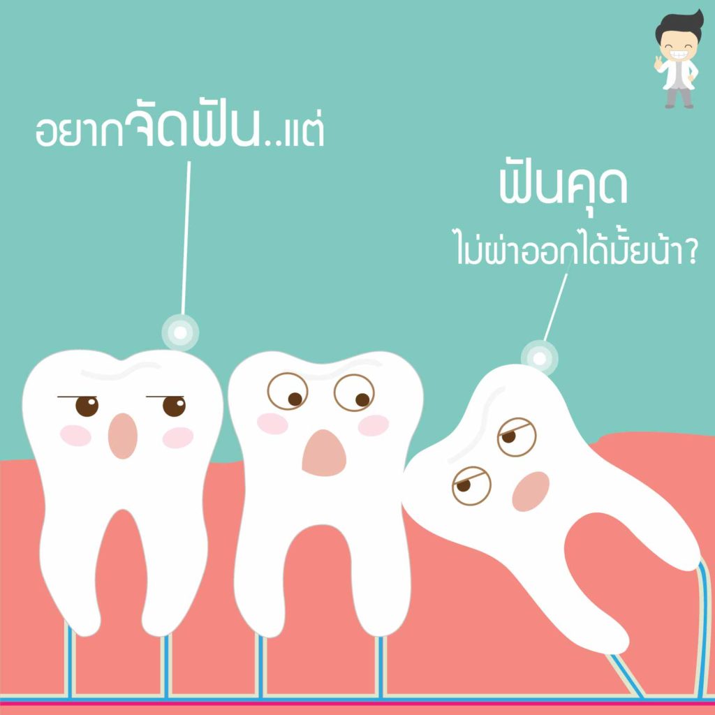 อยากจัดฟันแต่ "ฟันคุด" ไม่เอาออกได้มั้ย? คลายข้อข้องใจก่อนเคลียร์ช่องปาก 1 ฟันคุด 01 Copy